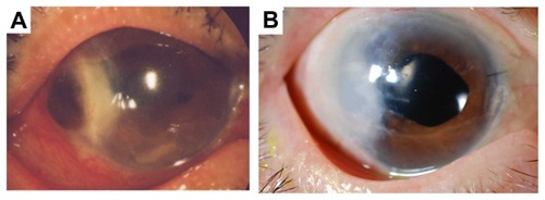 Figure 3 Case 3. (A) Perforation of the cornea 1 day after presentation at our hospital. (B) Eight months after surgery, the nasal cornea was clear, and the patient’s visual acuity was 0.8.
