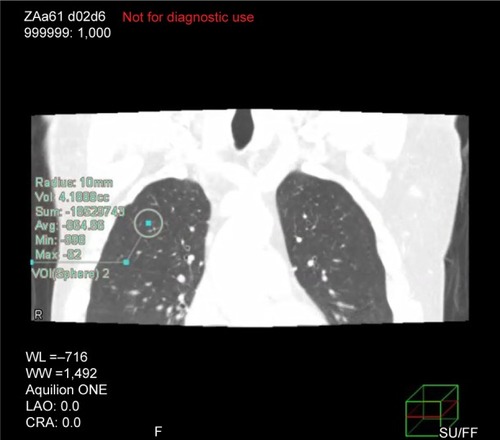 Figure 1 Example of continuous mean lung density measurements in the right upper lobe using PhyZiodynamics software (Ziosoft Inc., Minato-ku, Tokyo, Japan).