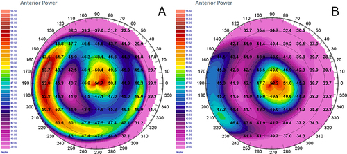 Figure 3 Computerized tomographic images of a 60 year-old female patient (F.S.) included in the cohort. (A) Preoperative the UDVA was 20/200, and the CDVA 20/100 with a refraction of −5 cyl ax180°. The Corneal Morphological Irregularity Index (CMI) was 32.3μm and the keratometric astigmatism (SimK) 3.8D (absolute scale, tangential algorithm). The planned optical zone was 5.65mm with a maximum ablation depth of 65µm, and an estimated residual pachymetry of 414µm. (B) 12-months following PRK the final postoperative UDVA was 20/25 and the CDVA 20/20 with a refraction of +0.50 ax40°. The CMI was 13.8μm and the keratometric astigmatism (SimK) was 1.3D. The minimum corneal thickness was 423µm, 9µm thicker than expected. The map’s image highlights the improved corneal profile obtained after customized topography-guided transepithelial PRK for treatment of persistent corneal infiltrates following adenovirus infection (absolute scale, tangential algorithm).