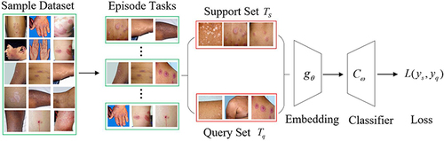 Figure 2 Episodic training mechanism in skin disease classification. A series of episode tasks are built from the sample dataset and divided into support set (Ts) and a query set (Tq). Convolutional neural network–based embedding backbone and classifier noted as fθ and Cw, respectively. Also, the classifier can be integrated with the embedding backbone into a unified network and trained in an end-to-end manner.
