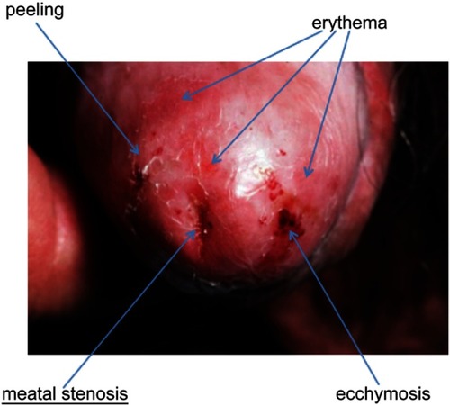 Figure 4 Urethral meatal stenosis associated with erythema, ecchymosis and peeling of the glans skin.