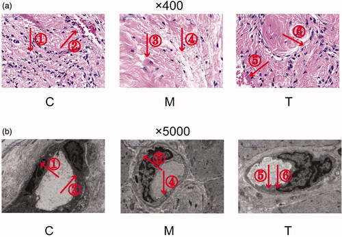 Figure 5 (a) H&E staining of the penile tissue of rats from the C, M, and T groups (×400). (i) In the C group: The trabeculae and blood sinuses were distributed evenly, and some red blood cells (RBCs) were in the sinus space, many smooth-muscle cells were in blood-containing sinus trabeculae. (Arrow ①②); (ii) In the M group: The number of blood-containing sinuses in the cavernous body was reduced significantly and its distribution was disordered, the density of endothelial cells and smooth muscle cells was decreased, and the number of collagen fibres was increased. (Arrow ③④); (iii) In the T group: the distribution of blood-containing sinuses was more regular than that in group M, the density of endothelial cells was increased, the number of collagen fibres was decreased, and RBCs were seen in some blood-containing sinuses. (Arrow ⑤⑥); (b) Ultrastructure of penile tissue of rats from the C, M, and T groups (×5000). (i) In the C group: the blood vessels of were normal, the morphology and structure of endothelial cells were basically normal, the nucleus was regular, the endothelial cells were closely connected, mitochondria and endoplasmic reticulum were observed in endothelial cells. (Arrow ①②); (ii) In the M group: Endothelial cells swelled, endothelial cell junction disappeared, endothelial cell mitochondria swelled and endoplasmic reticulum expanded. (Arrow ③④); (iii) In the T group: The blood vessels were normal, the morphology and structure of endothelial cells were basically normal, the endothelial cells were tightly connected, and mitochondria were seen in endothelial cells (Arrow ⑤⑥).