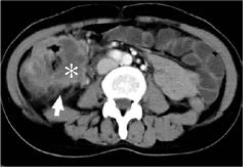 Figure 5 Computed tomography scan of 53-year-old woman with mucinous carcinoma in cecum and proximal ascending colon.