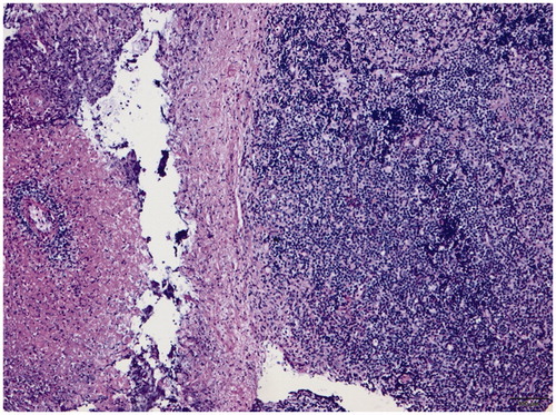 Figure 1. H&E stain (×100) showing a dense, diffuse, angiocentric lymphocytic infiltrate composed of small to medium-sized cells. There is extensive necrosis.