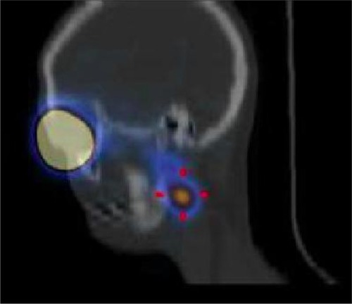 Figure 1 Single photon emission computed tomography/computed tomography demonstrating a submandibular sentinel lymph node (red arrows) with its anatomical references in a patient (case 3) with melanoma of the conjunctiva.
