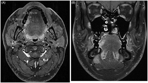 Figure 1. Tumor dimensions were measured from axial (A) and coronal (B) T1-weighted fat-suppressed contrast-enhanced MR images. MR: magnetic resonance; cm: centimetre.