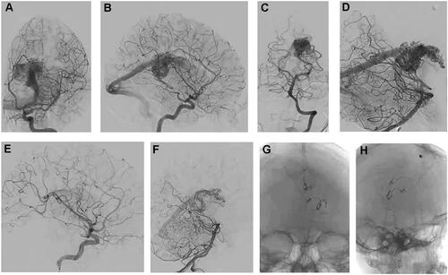 Figure 2 (A) PA left ICA, (B) lateral left ICA, (C) PA left basilar artery, and (D) lateral left basilar artery angiography showing the morphology of the splenium AVM supplied by the A5 segment of the left ACA and the lateral posterior choroidal artery branch of the left PCA and draining into the vein of Galen. (E) Lateral left ICA and (F) lateral left basilar artery angiography after occlusion of the feeding artery showing the significant regress of the AVM. (G) PA and (H) lateral skull X-rays showing the location of the Onyx® and devascularization sites.