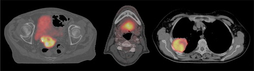 Figure 1. Axial PET/CT images illustrating 18F-FDG tumor uptake for the three different cases. Left: cervix cancer case. Mid: head and neck cancer case. Right: lung cancer case.