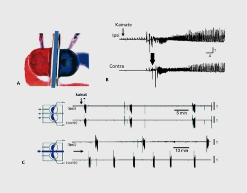 Figure 5. Seizures beget seizures in the immature hippocampus. A: A triple chamber is used (top left) with three compartments that accommodate each intact hippocampus and the connecting commissural connections. B: When the powerful convulsive agent kainate is applied, epileptiform activities are generated in the treated side and propagate rapidly to the naive side (top left). C: After repeated applications and seizure propagation to the naive side, tetrodoxin (TTX) a blocker of action potentials and of the propagation of seizures, was applied to the commissural chamber and effectively blocked seizures. Note (bottom part) that seizures were generated spontaneously by the naive hippocampus after disconnection form the treated side: there is formation of an epileptogenic mirror focus.Citation76