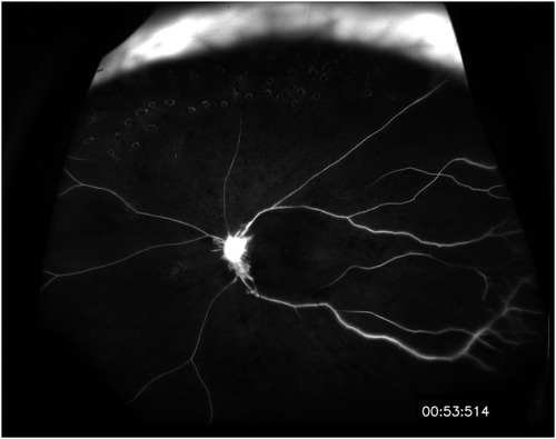 Figure 3 Fluorescein angiography of the patient at 6 weeks after the symptom occurred. Choroidal circulation was rarely seen; perfusion of retinal veins was faintly appreciable after 1 min, indicating impaired retinal and choroidal circulation. Informed consent was submitted by the patient.