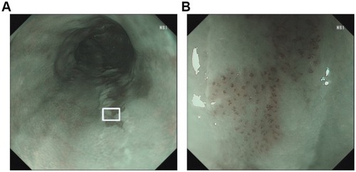 Figure 4 The NBI images of BLSCC. (A) Endoscopic image under NBI showed the lesion with brownish color change. (B) A magnified view of the white box area in Figure A. The IPCLs exhibited the changes of dilatation, meandering, irregular caliber, and form variation, belonging to JES type B1.Abbreviations: NBI, narrow-band imaging; IPCL, intraepithelial papillary capillary loop; JES, Japan Esophageal Society.
