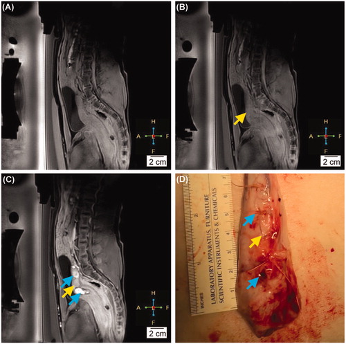 Figure 5. (A) The contrast-enhanced MRI before any intervention. (B) The contrast-enhanced MRI at the completion of the hyperthermia therapy. The yellow arrow indicates the location of the HT target. (C) The contrast-enhanced MRI right after ablation. The blue arrows indicate the location of the ablation lesions. (D) The gross pathology of the uterus after the completion of HT and ablation. The yellow arrow points to the location of the HT target. The blue arrow indicates the ablation lesions (thermal damage).