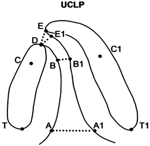 Figure 1. Schematic drawing of an infant maxillary dental cast with unilateral cleft lip and palate (UCLP). Landmarks and distances used in the linear measurements are demonstrated. D–E = cleft width at the level of the alveolar processes anteriorly; D–E1 = smallest cleft width at the level of the alveolar processes anteriorly; T–T1 = posterior width of the alveolar arch in the tuber area; A–A1 = width of the cleft at the level of T–T1; B–B1 = width of the cleft at the level of C–C1; B–B1/C–C1 = ratio of the cleft width related to the total alveolar arch width anteriorly at the level of the canine points; A–A1/T–T1 = ratio of the cleft width related to the total alveolar arch width posteriorly at the level of the tuberosity points.