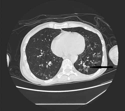 Figure 9. 37-year-old male with acute myeloid leukemia 26 days after bone marrow transplantation presenting with fever. High resolution CT scan obtained at level of lower lobes shows peripherally located nodules and micronodules with halo sign in left lower lobe (black narrow arrow).