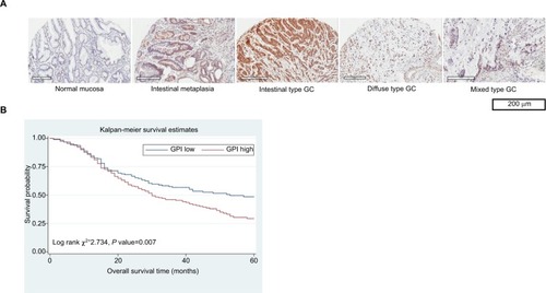 Figure 1 AMF/GPI expression in primary GC tissues and the survival in patients with GC.Notes: (A) Expression of AMF/GPI detected by immunohistochemical staining. (B) Kaplan–Meier survival curves of overall survival in all 335 patients of AMF/GPI negative vs AMF/GPI positive.Abbreviations: AMF, autocrine motility factor; GC, gastric cancer; GPI, glucose-6-phosphate isomerase.