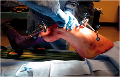 Figure 1. Initial setup of bone trackers during a Navio TKA procedure. The bone arrays are fixed using bone screws on the femur and the tibia.