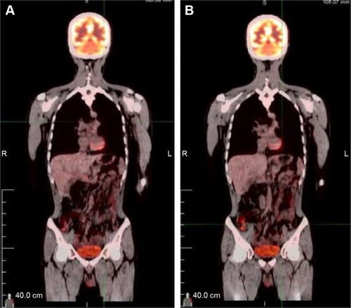 Figure 4 A PET-CT did not detect any signs of disease recurrence after 16 months.Notes: A and B represent different planes on PET-CT.