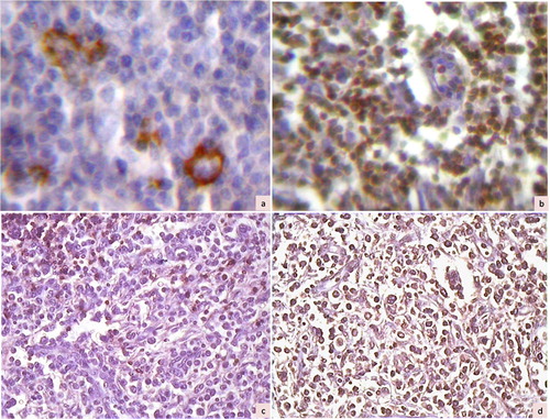 Figure 2. Immunohistochemical photomicrographs showing a case of T cell-rich B-cell lymphoma with large cells positive for CD20 (a, ×200) and small lymphocytes in the background staining for CD45RO (b, ×200). Another case of lymphoma (diffuse mixed small and large by Working Formulation) showing negative staining for CD20 (c, ×100) and diffuse positive staining for CD45RO (d, ×100), suggestive of T-cell lymphoma.