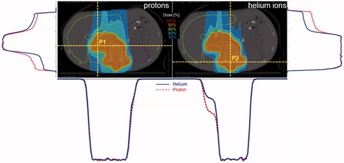 Figure 2. Isodose distributions (left: protons, right: 4He) of a representative Neuroblastoma patient. Corresponding horizontal and vertical dose profiles for two positions on the depicted slice are shown as well. The profiles on the left side (vertical profile) and below the proton isodose distribution (horizontal profile) belong to P1, the one on the right side (vertical profile) and below the 4He distribution (horizontal profile) belong to P2. The solid lines (blue) of the dose profiles represent 4He, the dotted (red) protons. Color figure available online.