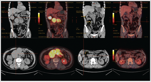 Figure 2. PET/CT scan before the start of treatment (A) and after three cycles of R2-GDP (B). The yellow arrows demonstrated the lesions where abdominal masses disappeared (B).