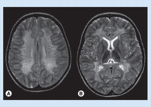 Figure 2. MRI in juvenile metachromatic leukodystrophy.(A) The central white matter shows signal hyperintensity and a streaky pattern, while the subcortical U fibers are spared. (B) Involvement of corpus callosum and posterior limb of internal capsule.