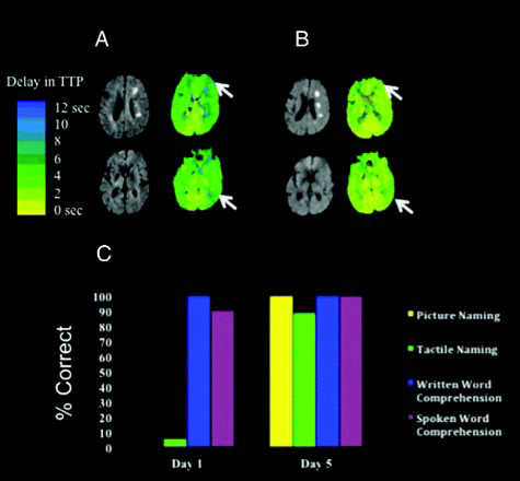 Figure 2. (A) Participant 1's DWI (left) and PWI (right) before intervention to restore blood flow shows hypoperfusion of left frontal and inferior temporal cortex, and acute infarcts in subcortical watershed areas. TTP = time-to-peak. (B) DWI and PWI post intervention shows reperfusion of left frontal and inferior temporal cortex (and unchanged acute subcortical infarcts). (C) Language testing shows improvement in oral picture naming and oral naming of objects from tactile input after reperfusion of left frontal and inferior temporal cortex. [To view this figure in colour, please see the online version of this journal.]