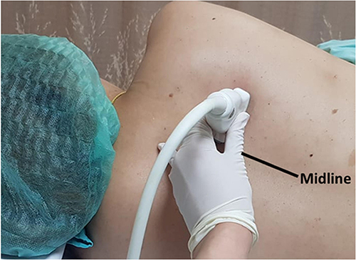 Figure 1 Anatomical landmark and a linear transducer position for transverse plane of paravertebral space at the level of T4-5.