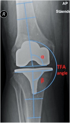 Figure 1. Example of measurements of femoral and tibial TKA component placement in the coronal plane with respect to the femoral and tibial anatomical axes, respectively, according to Petersen and Engh (Citation1988) and as used by e.g. Ritter et al. (Citation2011). Placement of the femoral component is measured using the angle (α) between the line across the bottom of the femoral condyles and femoral shaft axis. α = 90 corresponds to neutral placement, α > 90 corresponds to valgus placement of the femoral component, and α < 90 corresponds to varus placement of the femoral component. Placement of the tibial component is measured using the angle (β) between the line across the base of the tibial plate and the tibial shaft axis. β = 90 corresponds to neutral placement, β > 90 corresponds to valgus placement of the tibial component, and β < 90 corresponds to varus placement of the tibial component. TFA stands for tibiofemoral axis, measured at the angle between the tibial and femoral shaft axes (TFA angle). TFA angle = 180 corresponds to neutral alignment, TFA angle > 180 correponds to TFA in valgus, and TFA angle < 180 corresponds to TFA in varus.