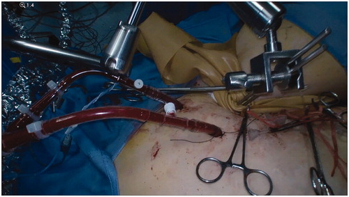 Figure 1. Esmarch tourniquet applied at the proximal limit of the limb, fixed with Steinman orthopaedic pins inserted into the iliac crest and held in place by a Martin’s arm retractor.