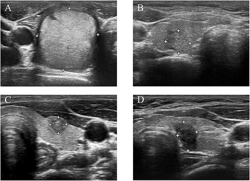 Figure 2 The ultrasound images of four thyroid nodules with or without HT. (A) Benign nodule without HT, solid, hyperechoic, wider than tall shape, smooth margin, no echogenic foci; (B) Benign nodule with HT, almost completely solid, isoechoic, wider than tall shape, smooth margin, no echogenic foci; (C) Malignant nodule without HT, solid, hypoechoic, taller than wide shape, smooth margin, macro-calcifications; (D) Malignant nodule with HT, solid, hypoechoic, taller than wide shape, irregular margin, no echogenic foci.