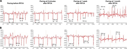 Figure 3 The representative electrophysiological recordings of two groups in four different phases.Notes: Group A, RFCA (A); Group C, RFCA+L-DOX (B). The dotted line indicates the start of pacing stimulation. n=10 per group.Abbreviations: L-DOX, liposomal doxorubicin; RFCA, radiofrequency catheter ablation.