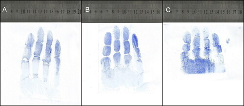 Figure 2. Glove impression marks when the same gloved hand grasped objects of 6 cm (A), 4 cm (B) and 2 cm (C) in diameter.
