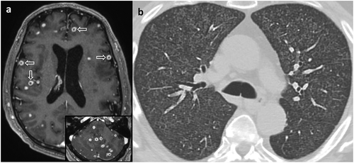 Figure 1. (a) Representative T1-weighted axial image from magnetic resonance imaging of the brain with gadolinium shows numerous ring-enhancing lesions in both cerebral hemispheres (arrows). These lesions were particularly densely concentrated in the cerebellum of this patient (inset, lower right). (b) Chest computed tomography axial image at the level of the upper lobes demonstrates diffuse bilateral involvement with innumerable micronodules