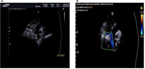 Figure 2 Transthoracic echocardiogram parasternal short axis view.Notes: (A and B) Transthoracic echocardiogram. (A) (2D mode) in parasternal short axis view demonstrating absence of the right pulmonary artery with main pulmonary artery continuing as left pulmonary artery. (B) (Color flow mode) shows a parasternal short axis view demonstrating presence of flow only through main pulmonary artery and left pulmonary artery.