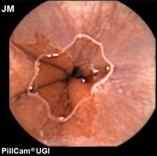 Figure 1. Gastro-oesophageal junction as seen with the Upper GI capsule.
