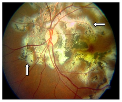 Figure 2 Serpiginous choroidopathy with snake-like chorioretinal involvement (arrows) in a 45-year-old man.Photograph courtesy of Dhanjay Shukla.