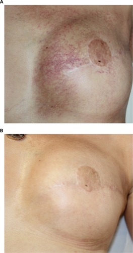 Figure 2 Example of results obtained after two sessions of vascular laser and two sessions of fractional non-ablative laser.