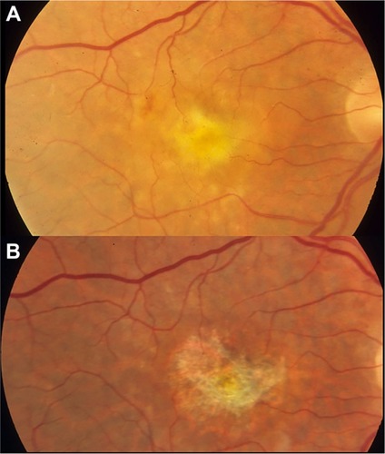 Figure 3 An eye with neovascularization-associated RPE atrophy at the baseline (A) and 30 months after anti-VEGF treatment (B).