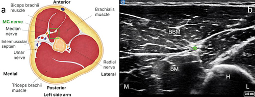 Figure 3. Identification of the musculocutaneous nerve in the interfascial muscle plane deep to the biceps brachii and superficial to the brachialis. (a) Anatomical illustration depicting the musculocutaneous nerve in the interfascial muscle plane deep to the biceps brachii and superficial to the brachialis (left side). (b) Corresponding ultrasound scan showing the musculocutaneous nerve and its relation to adjacent structures (right side). Note: The green square in the left-hand figure shows the area of interest, with the musculocutaneous nerve in the interfascial plane deep to the biceps brachii and superficial to the brachialis. BBM = biceps brachii muscle; BM = brachialis muscle; H = humerus; L = lateral; M = medial. *Musculocutaneous nerve.