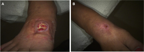 Figure 1 Case 1 surgical wound.