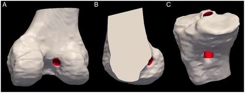 Figure 6. The virtual drill bits were cropped to match the tunnel aperture on the femur and tibia. Several views are provided, including the posterior aspect of the distal femur (A), a sagittal view of just the lateral femoral condyle (B), and the tibia (C).