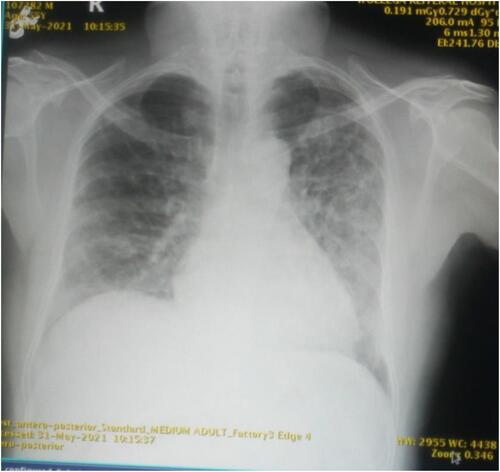 Figure 1 Chest X-ray result showing perihilar patchy opacities.