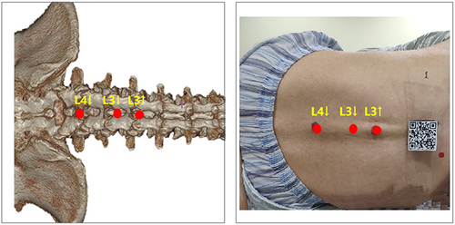 Figure 5 Method of projecting the virtual image over the real spine. L3↑: Upper edge of the L3 spinous process. L3↓: Lower edge of the L3 spinous process. L4↓: Lower edge of the L4 spinous process.