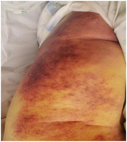 Figure 1 Diffuse cutaneous hemorrhage over the thigh.