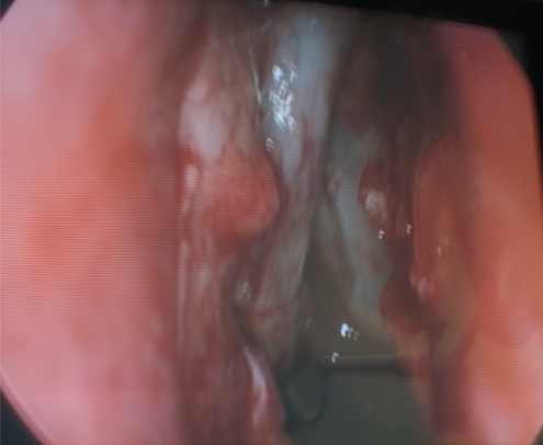 Figure 2 Nasoendoscopic view of bony nasal lacrimal canal. The canal is formed by the maxilla, the lacrimal bone and the inferior nasal concha.