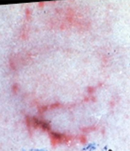 Figure 4. People vs. Bundy: Bite mark wound on buttocks of victim. Source: Richard Souviron, DDS, D-ABFO.