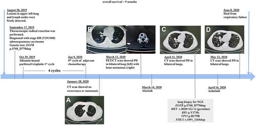 Figure 1 A summary of patient’s treatment history and CT images accordingly. (A) CT scan showed no recurrence or metastasis on Jan 28, 2020. (B) PET/CT scan showed PD in bilateral lung (left) with bone metastasis (right) on Mar 11, 2020. (C) CT scan showed PD in bilateral lungs on Apr 13, 2020. (D) CT scan showed PD in bilateral lungs on May 12, 2020.