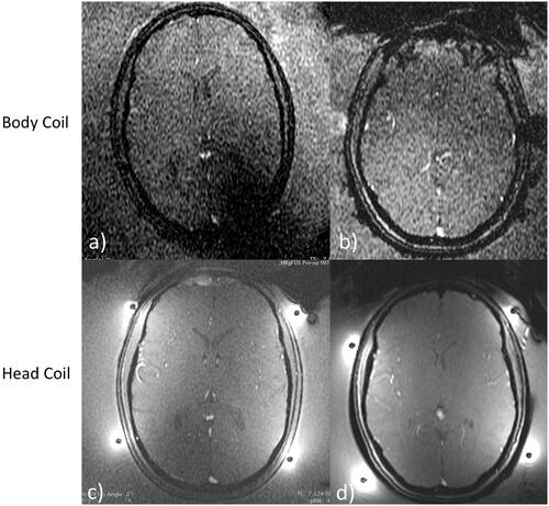 Figure 6. Comparison of image quality of GRE thermometry magnitude images in two volunteers without (a, b) and with (c, d) the tcMRgFUS head coil in the transducer water bath treatment setup.