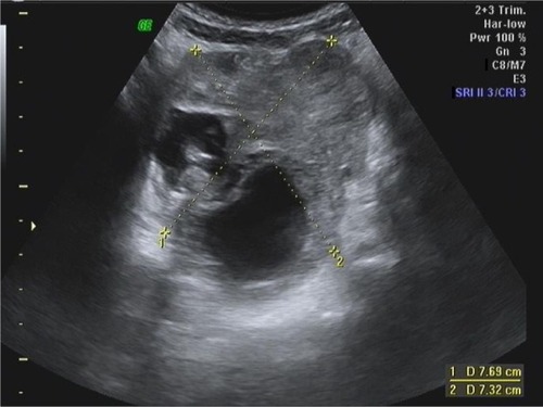 Figure 4 Transabdominal scan in a 9-year-old girl.