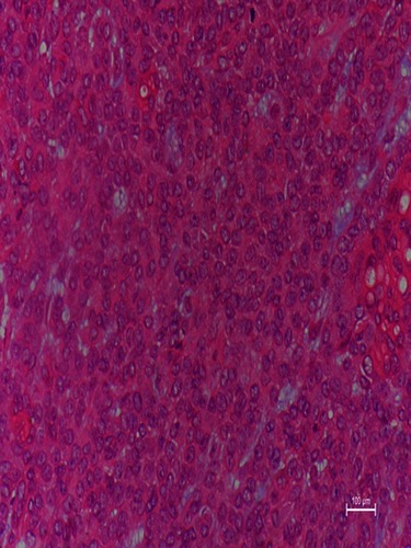 Figure 5 Microscopic examination showed frankly malignant areas composed of hyperchromatic nuclei with prominent nucleoli, trabeculae of cells with pleomorphic, back-to-back glands, and numerous mitotic figures/apoptotic bodies (hematoxylin and eosin, 200).